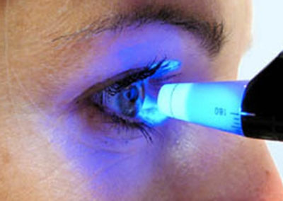 Curva tensional diária para glaucoma