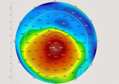 Topografia de córnea